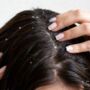 Dandruff and Dry Scalp: Causes & Ayurvedic Solutions